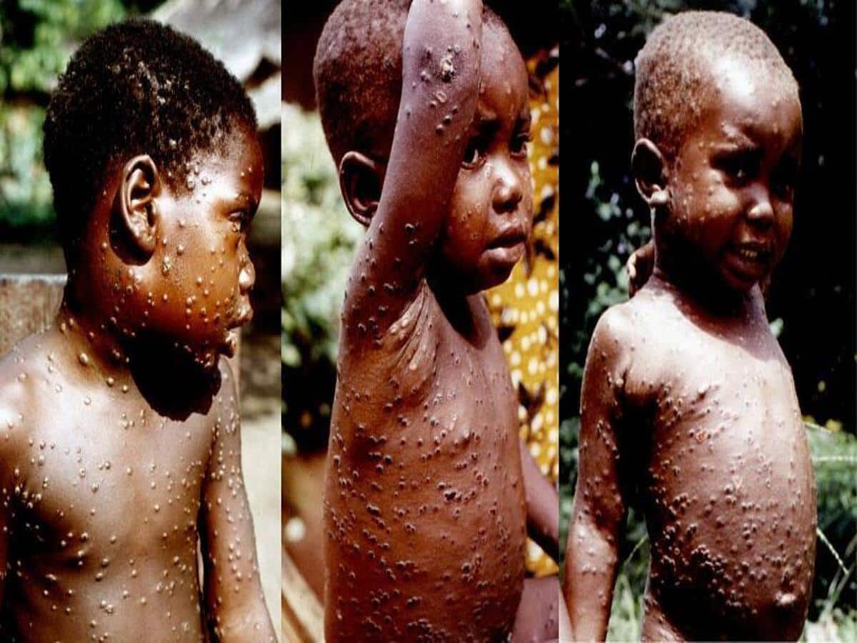 Monkeypox symptoms in Kids in hindi : बच्चों में दिखे Monkeypox Virus के ये 5 असामान्य लक्षण तो हो जाएं सावधान! करीब जाने से बचें